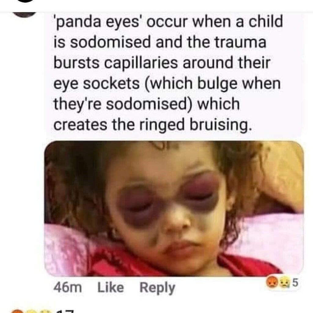 Ojos Panda (Black Eye Pedo and Panda Eyes)